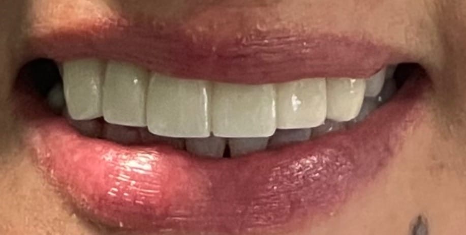 Después: rehabilitación fija en zirconio y blanqueamiento, sonrisa natural