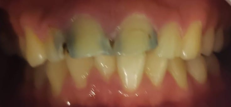 Antes: caries interproximales y compromiso estético en el sector anterior