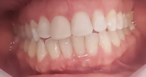 Después: rehabilitación estética con carilla en resina, sonrisa uniforme