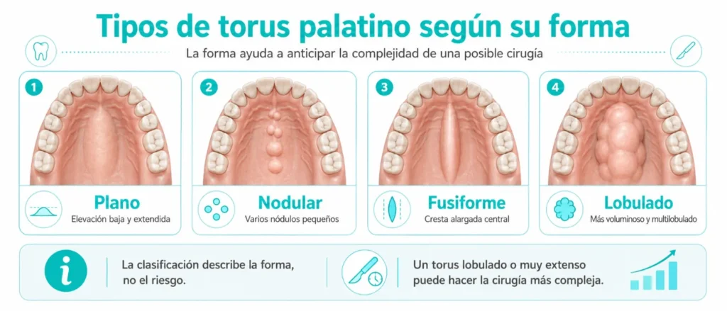 Tipos de torus palatino segun su forma