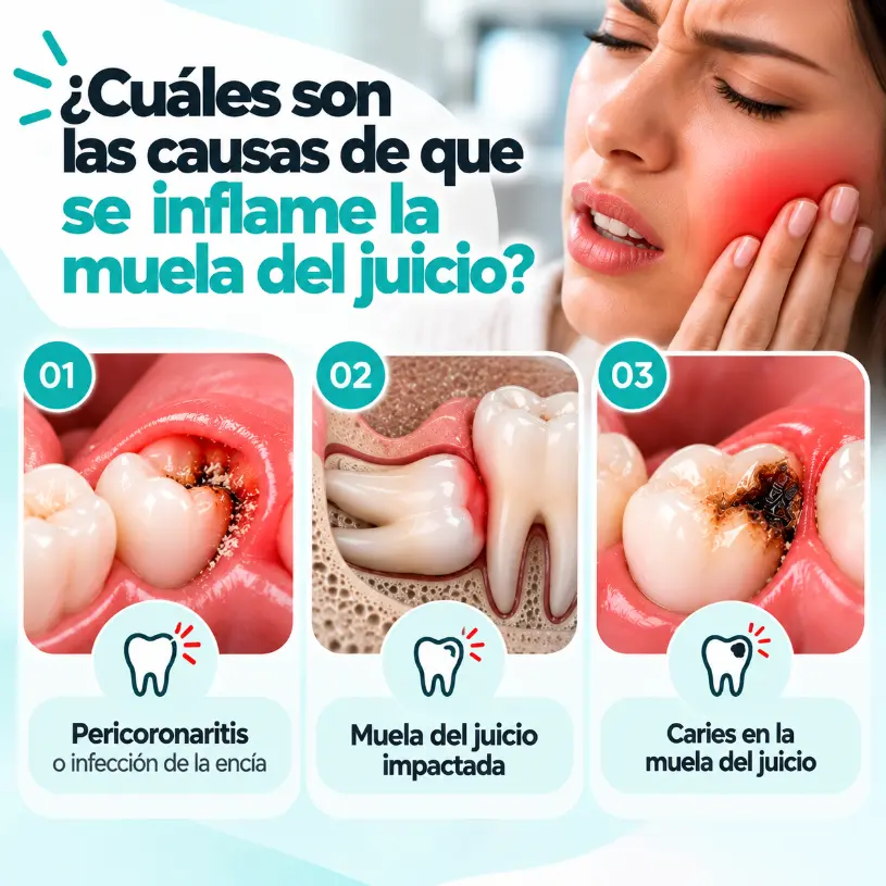 Cuales son las causas de que se inflame la muela del juicio